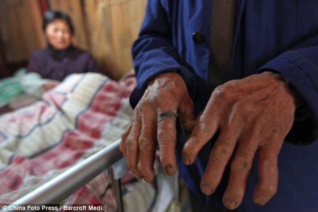 Bố mẹ ng&agrave;y đ&ecirc;m b&oacute;p b&oacute;ng thở suốt 5 năm trời gi&uacute;p con duy tr&igrave; sự sống, dừng lại 3 ph&uacute;t con sẽ chết - Ảnh 5.