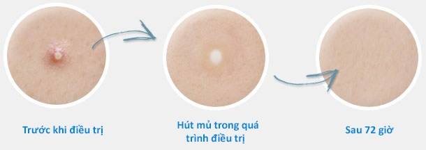 9 miếng dán mụn dễ mua dễ tìm, lại tiêu diệt mụn nhanh gọn chỉ sau 72 giờ - Ảnh 7.