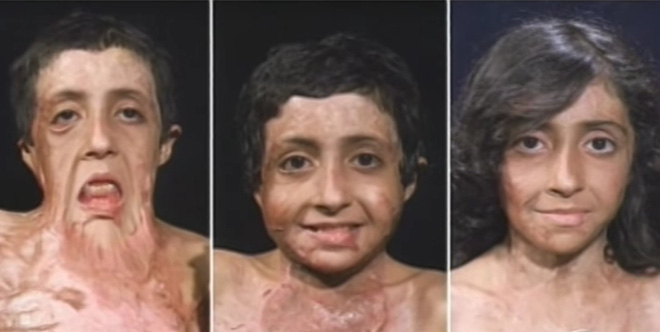 Con gái 9 tuổi bị bỏng đến tan chảy khuôn mặt, cha cầu cứu suốt 4 năm và phép màu đã đến - Ảnh 8.