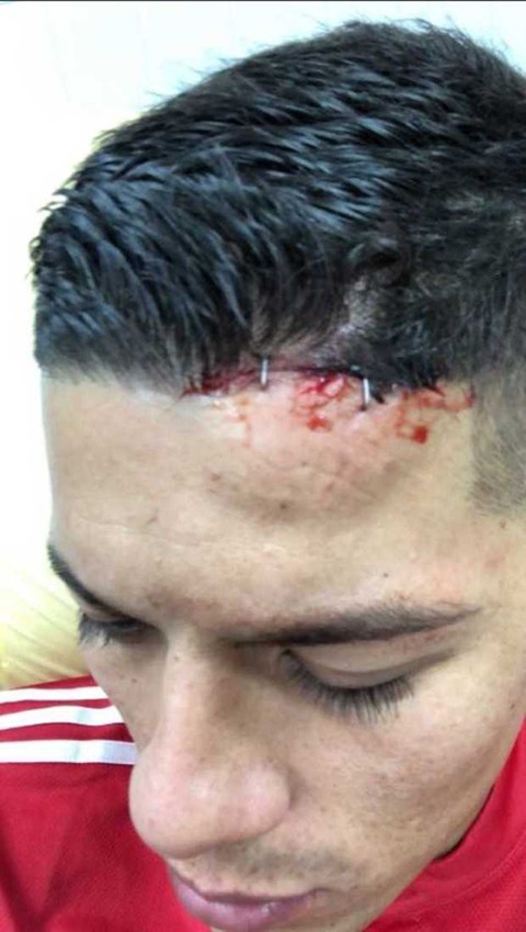 CẬN CẢNH: Rợn người với chấn thương ở đầu Marcos Rojo, phải dùng kẹp ghim để vá lại - Ảnh 8.