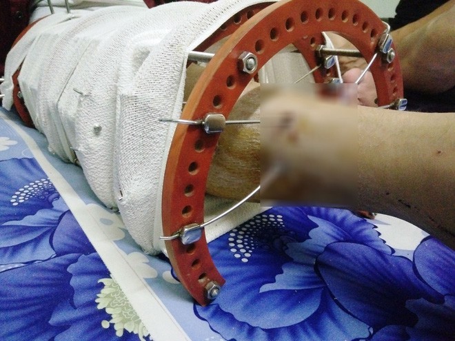 Mẹ vừa mới mất, người cha đau đớn nh&igrave;n con g&aacute;i 15 tuổi mắc bệnh ung thư xương &aacute;c t&iacute;nh m&agrave; kh&ocirc;ng tiền chữa trị - Ảnh 10.