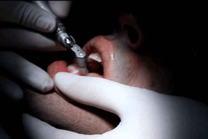 Xem chuyên gia bật mí quy trình hô biến răng vàng ố thành răng trắng - Ảnh 2.