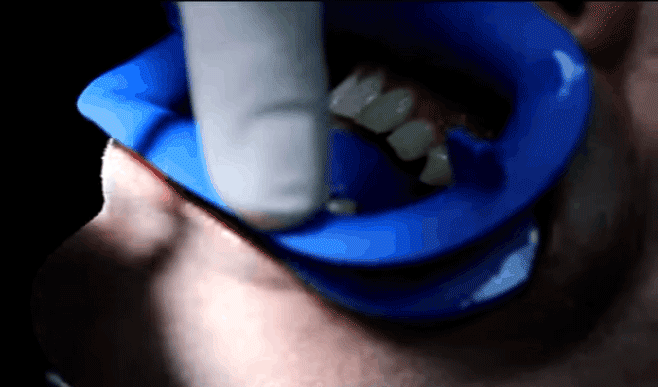 Xem chuyên gia bật mí quy trình hô biến răng vàng ố thành răng trắng - Ảnh 3.