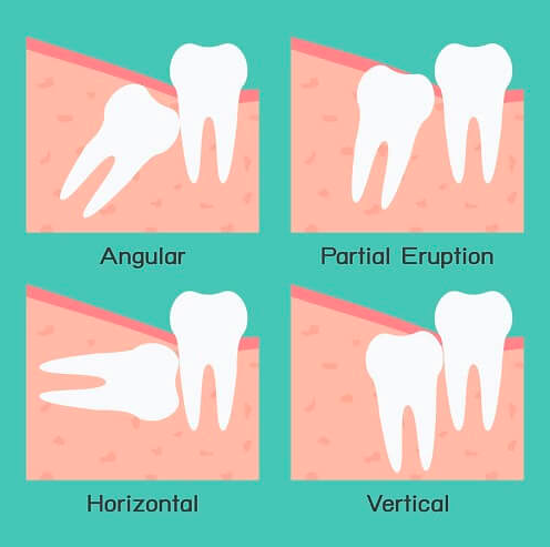 Chuyên gia giải đáp: Vì sao răng khôn thi thoảng trồi lên như 1 vị thần? - Ảnh 2.