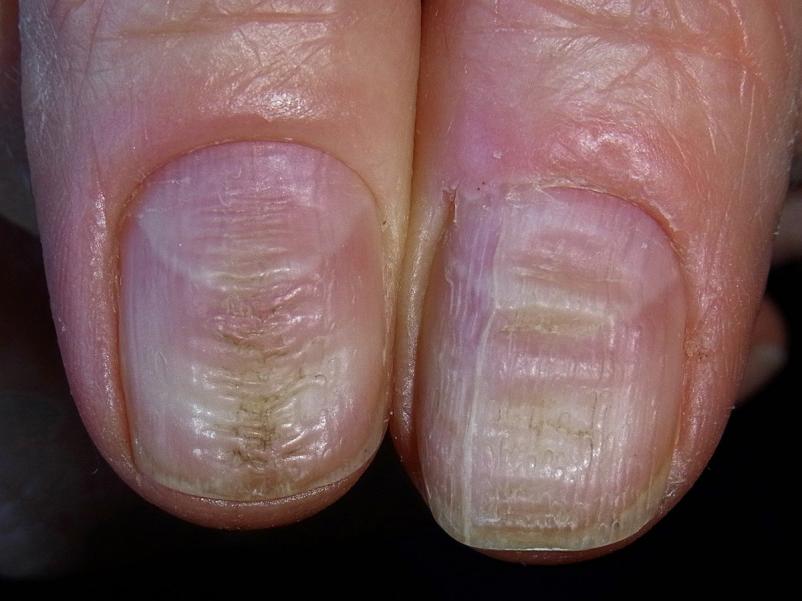 Đừng bỏ qua những “đường vân” trên móng tay, đó là chìa khóa báo hiệu tình  trạng dinh dưỡng của bạn