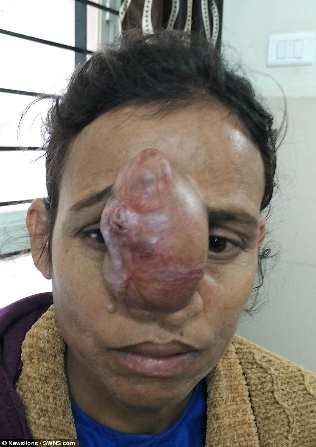 Người phụ nữ không thể hôn chồng vì khối u vướng víu trên mũi - Ảnh 1.