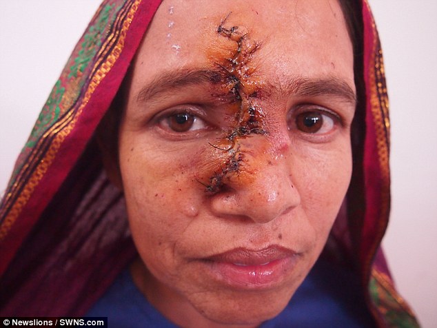 Người phụ nữ không thể hôn chồng vì khối u vướng víu trên mũi - Ảnh 2.
