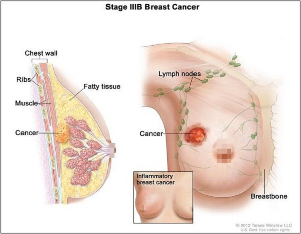Bức ảnh này có thể giúp bạn nhận biết nhanh và rõ hơn bệnh ung thư phổ biến nhất ở XX - Ảnh 2.
