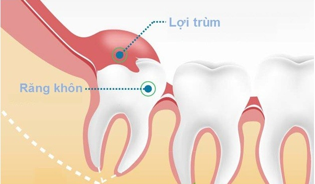 Đau răng khôn thì ai cũng từng nhưng đâu là cảnh giới của sự nguy hiểm thì mấy ai biết - Ảnh 1.