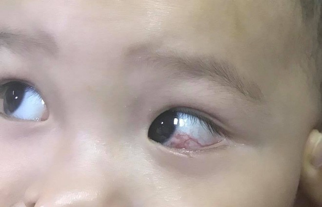 Cha mẹ chở đi bão mừng U23 Việt Nam chiến thắng, bé trai 16 tháng tuổi bị cán cờ quẹt chảy máu tròng mắt - Ảnh 1.