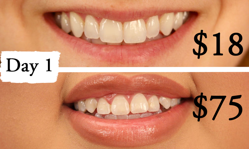 Thử làm trắng răng  với 2 sản phẩm đắt và rẻ tiền, 2 cô nàng này đã nhận được kết quả ngoài dự kiến - Ảnh 6.