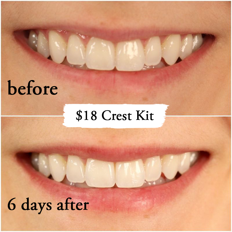 Thử làm trắng răng với 2 sản phẩm đắt và rẻ tiền, 2 cô nàng này đã nhận được kết quả ngoài dự kiến - Ảnh 9.