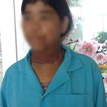 Người phụ nữ mang khối bướu “khổng lồ” ở cổ suốt 35 năm - Ảnh 2. Người phụ nữ mang khối bướu “khổng lồ” ở cổ suốt 35 năm - Ảnh 2.