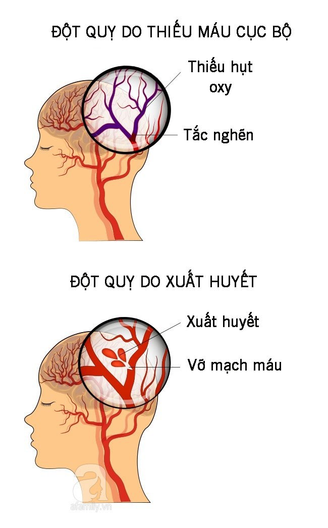 7 triệu chứng đột quỵ ở phụ nữ dù còn trẻ chị em cũng không được bỏ qua - Ảnh 2.