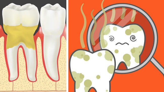 Cẩn thận mắc bệnh viêm nướu răng nếu gặp phải 5 dấu hiệu sau - Ảnh 2.