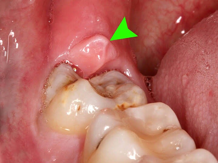 Cẩn thận mắc bệnh viêm nướu răng nếu gặp phải 5 dấu hiệu sau - Ảnh 3.