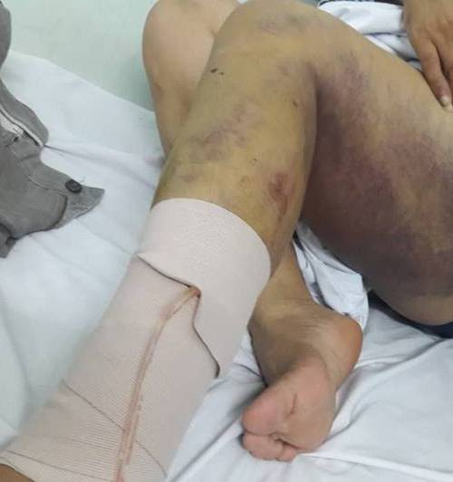 Hải Phòng: Người đàn ông kiệt quệ sau khi bị bạn gái thuê 5 côn đồ truy sát - Ảnh 6. Hải Phòng: Người đàn ông kiệt quệ sau khi bị bạn gái thuê 5 côn đồ truy sát - Ảnh 6.