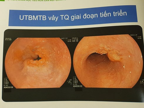 PGS Nhật Bản chỉ rõ đối tượng có nguy cơ cao mắc ung thư thực quản - Ảnh 2.