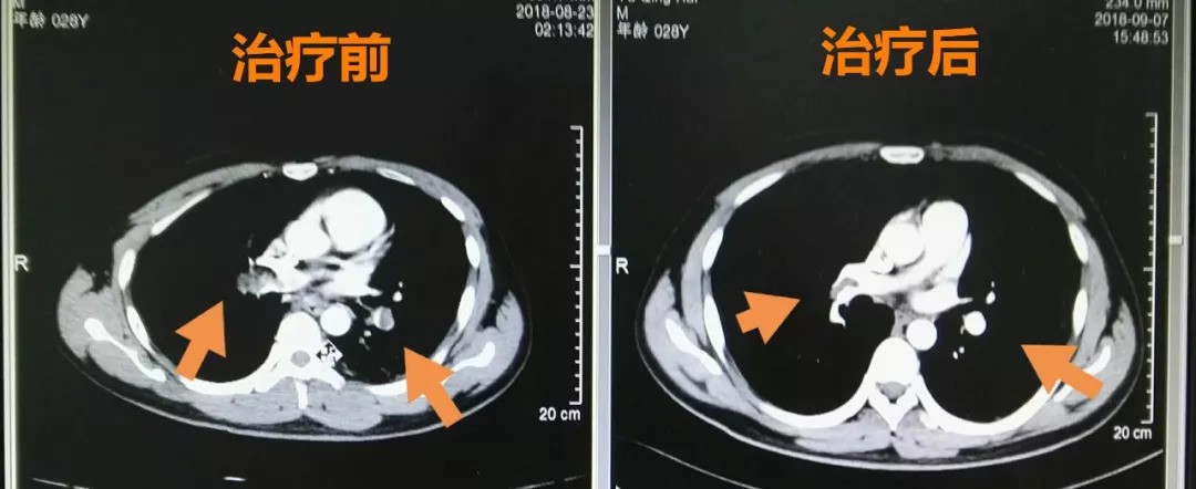 Chàng trai 28 tuổi mắc bệnh thuyên tắc phổi vì thói quen mà hầu hết dân văn phòng đều mắc phải - Ảnh 2. Chàng trai 28 tuổi mắc bệnh thuyên tắc phổi vì thói quen mà hầu hết dân văn phòng đều mắc phải - Ảnh 2.