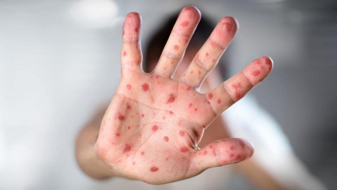 Phong trào anti-vaccine khiến dịch sởi quay lại tấn công Châu Âu và nước Mỹ - Ảnh 1.