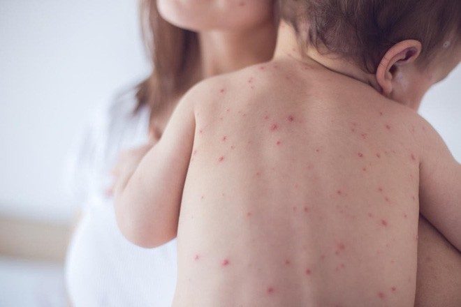 Phong trào anti-vaccine khiến dịch sởi quay lại tấn công Châu Âu và nước Mỹ - Ảnh 3.