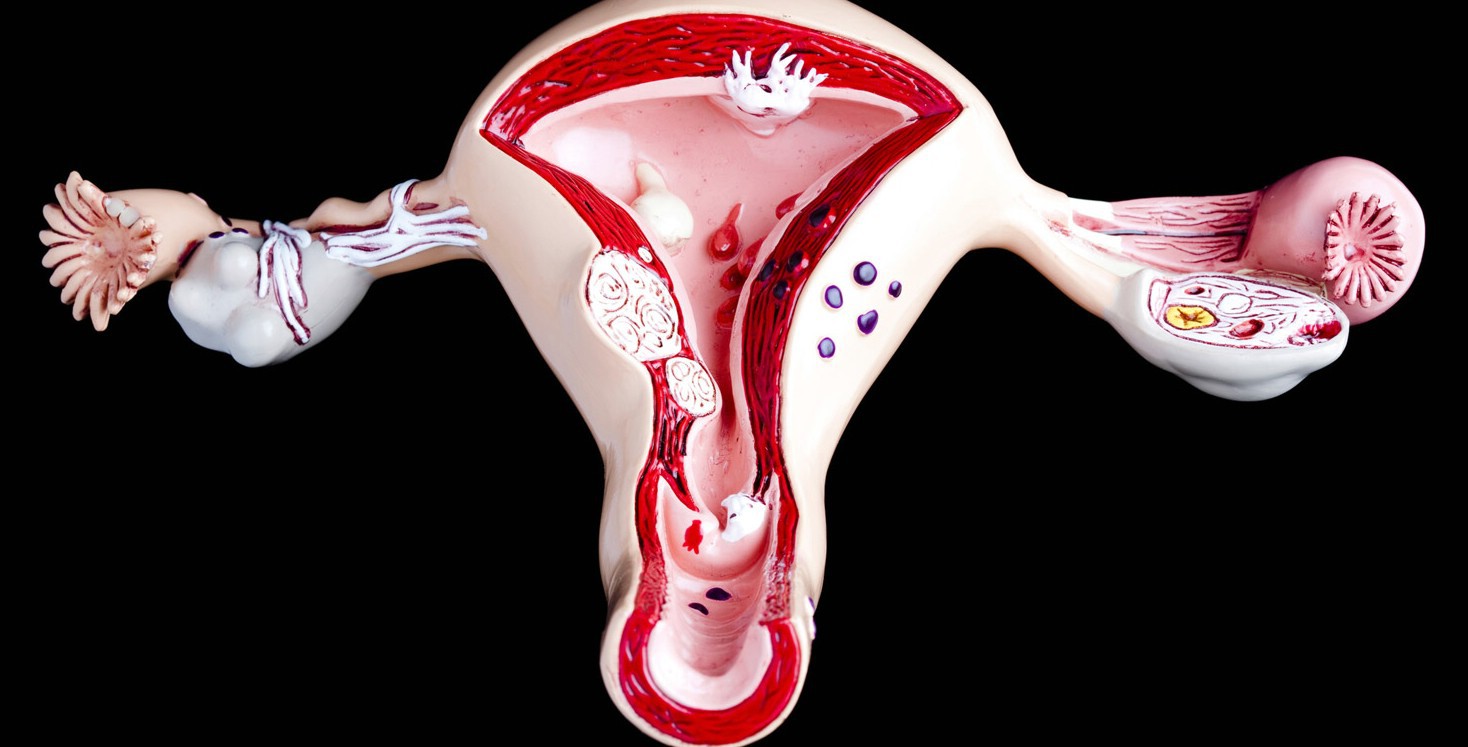 Маточное кровотечение при беременности. Аденомиоз и эндометриоз.