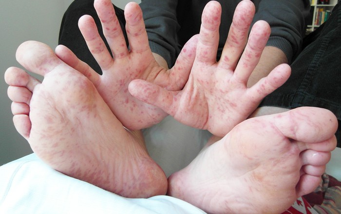 Bệnh tay chân miệng đang vào mùa dịch và dưới đây là những điều mà cả người lớn lẫn trẻ nhỏ đều phải biết - Ảnh 4. Bệnh tay chân miệng đang vào mùa dịch và dưới đây là những điều mà cả người lớn lẫn trẻ nhỏ đều phải biết - Ảnh 4.