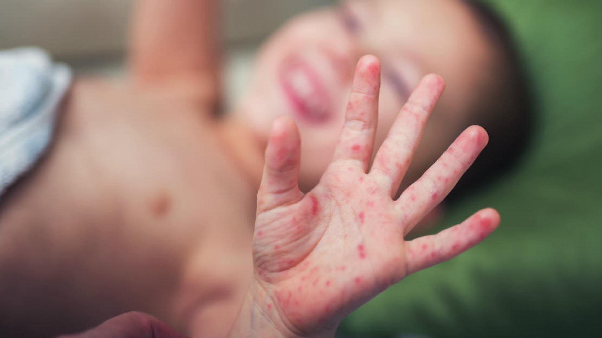 Bệnh tay chân miệng đang vào mùa dịch và dưới đây là những điều mà cả người lớn lẫn trẻ nhỏ đều phải biết - Ảnh 3. Bệnh tay chân miệng đang vào mùa dịch và dưới đây là những điều mà cả người lớn lẫn trẻ nhỏ đều phải biết - Ảnh 3.