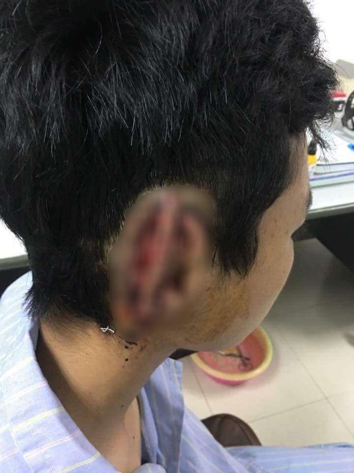 Nam sinh nghi ngáo đá cắn đứt rồi nuốt tai phải của bạn vào bụng - Ảnh 1. Nam sinh nghi ngáo đá cắn đứt rồi nuốt tai phải của bạn vào bụng - Ảnh 1.