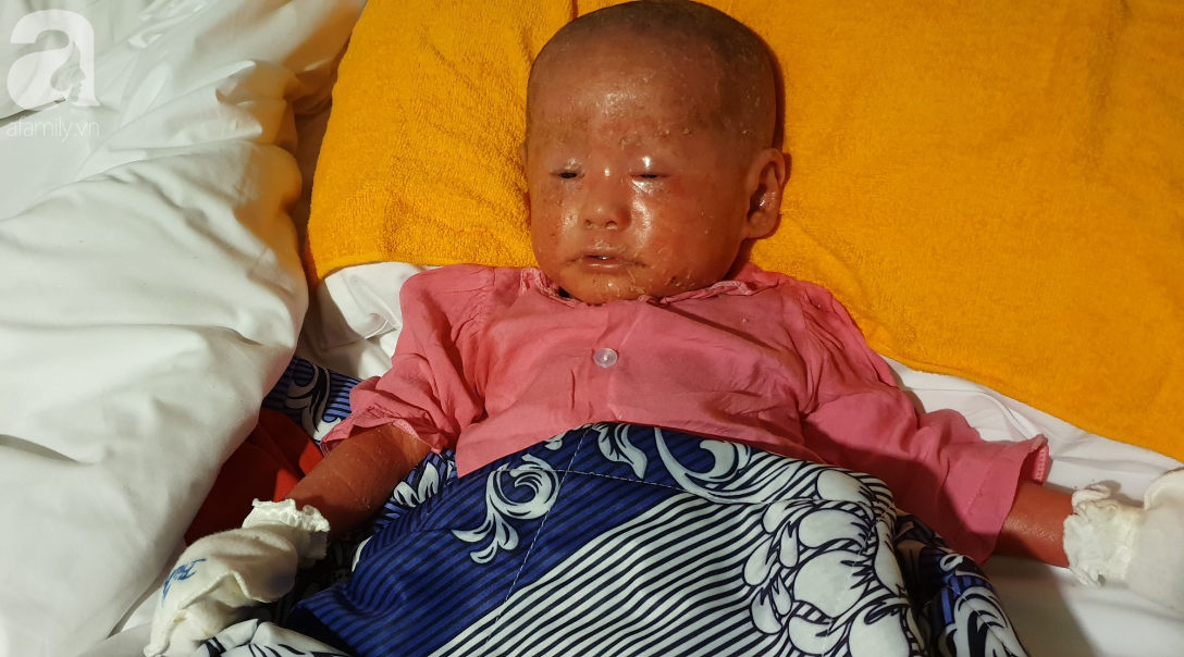 Hình ảnh mới nhất của bé Bích bị bỏ rơi, người đầy vẩy ngứa như da trăn sau đợt khám bệnh đầu tiên tại Singapore - Ảnh 3. Hình ảnh mới nhất của bé Bích bị bỏ rơi, người đầy vẩy ngứa như da trăn sau đợt khám bệnh đầu tiên tại Singapore - Ảnh 3.