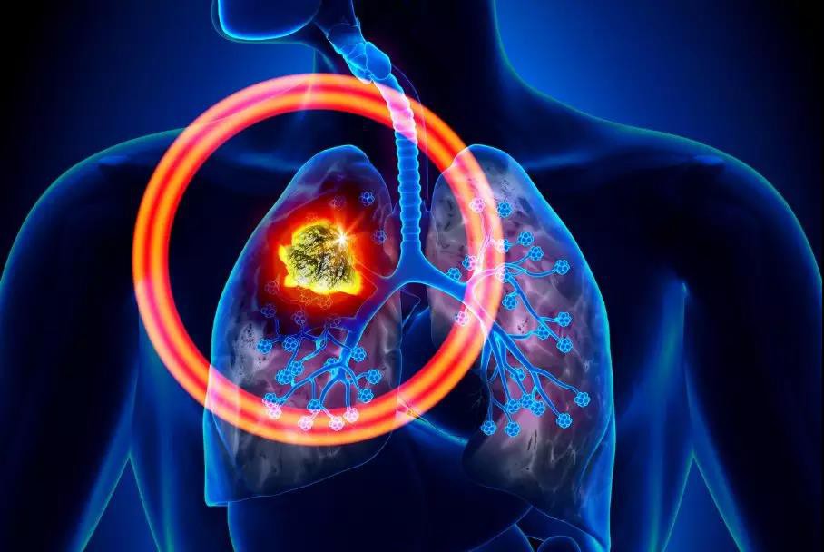 Đây là 6 căn bệnh ung thư gây tử vong hàng đầu thế giới nhưng nhiều người lại chưa nắm rõ - Ảnh 2. Đây là 6 căn bệnh ung thư gây tử vong hàng đầu thế giới nhưng nhiều người lại chưa nắm rõ - Ảnh 2.