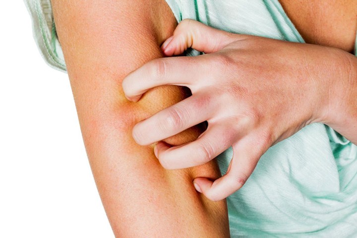Da bị ngứa, mẩn đỏ cảnh báo vấn đề gì về sức khỏe? - Ảnh 3. Da bị ngứa, mẩn đỏ cảnh báo vấn đề gì về sức khỏe? - Ảnh 3.