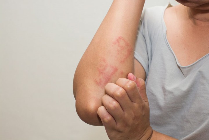 Da bị ngứa, mẩn đỏ cảnh báo vấn đề gì về sức khỏe? - Ảnh 6. Da bị ngứa, mẩn đỏ cảnh báo vấn đề gì về sức khỏe? - Ảnh 6.
