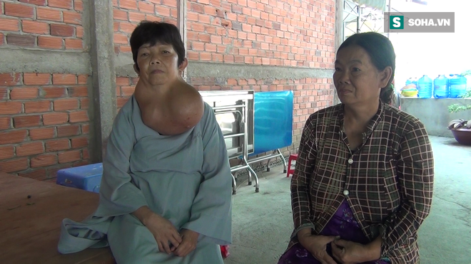 Người phụ nữ ở Tiền Giang mang bướu cổ khủng 5 kg gần 30 năm - Ảnh 2. Người phụ nữ ở Tiền Giang mang bướu cổ khủng 5 kg gần 30 năm - Ảnh 2.