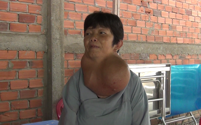 Người phụ nữ ở Tiền Giang mang bướu cổ khủng 5 kg gần 30 năm - Ảnh 1.