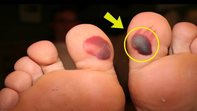 Ch&acirc;n bị phồng rộp ai cũng muốn chọc vỡ, nhưng đ&acirc;y l&agrave; l&yacute; do bạn kh&ocirc;ng n&ecirc;n l&agrave;m như vậy - Ảnh 2.