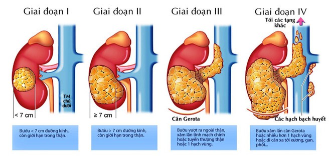 Ung thư thận: không can thiệp sớm thì chỉ sống được khoảng 1 năm và đây là 3 dấu hiệu nhận biết điển hình - Ảnh 1.