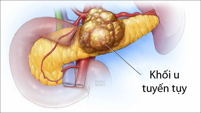 Đây là những dấu hiệu ung thư tuyến tụy mà cơ thể đang cố cảnh báo nhưng lại bị bạn lờ đi - Ảnh 1.