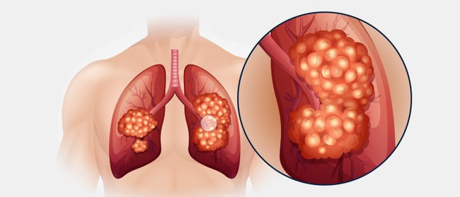 Từ một cái hắt hơi mạnh co thắt cơ lưng, cô gái 19 tuổi tràn trề nhựa sống bỗng phải nhận án ung thư phổi - Ảnh 4.