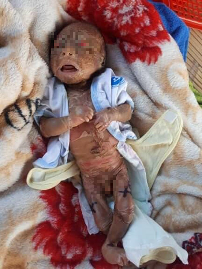 Tây Ninh: Bé trai chưa đầy 1 tháng tuổi, người đầy vảy ngứa như da trăn bị bố mẹ bỏ rơi ngoài đường - Ảnh 1.