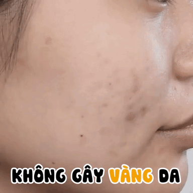 H&ocirc; biến da sạch mụn hết th&acirc;m chỉ nhờ một bảo bối nhỏ n&agrave;y đ&acirc;y! - Ảnh 2.