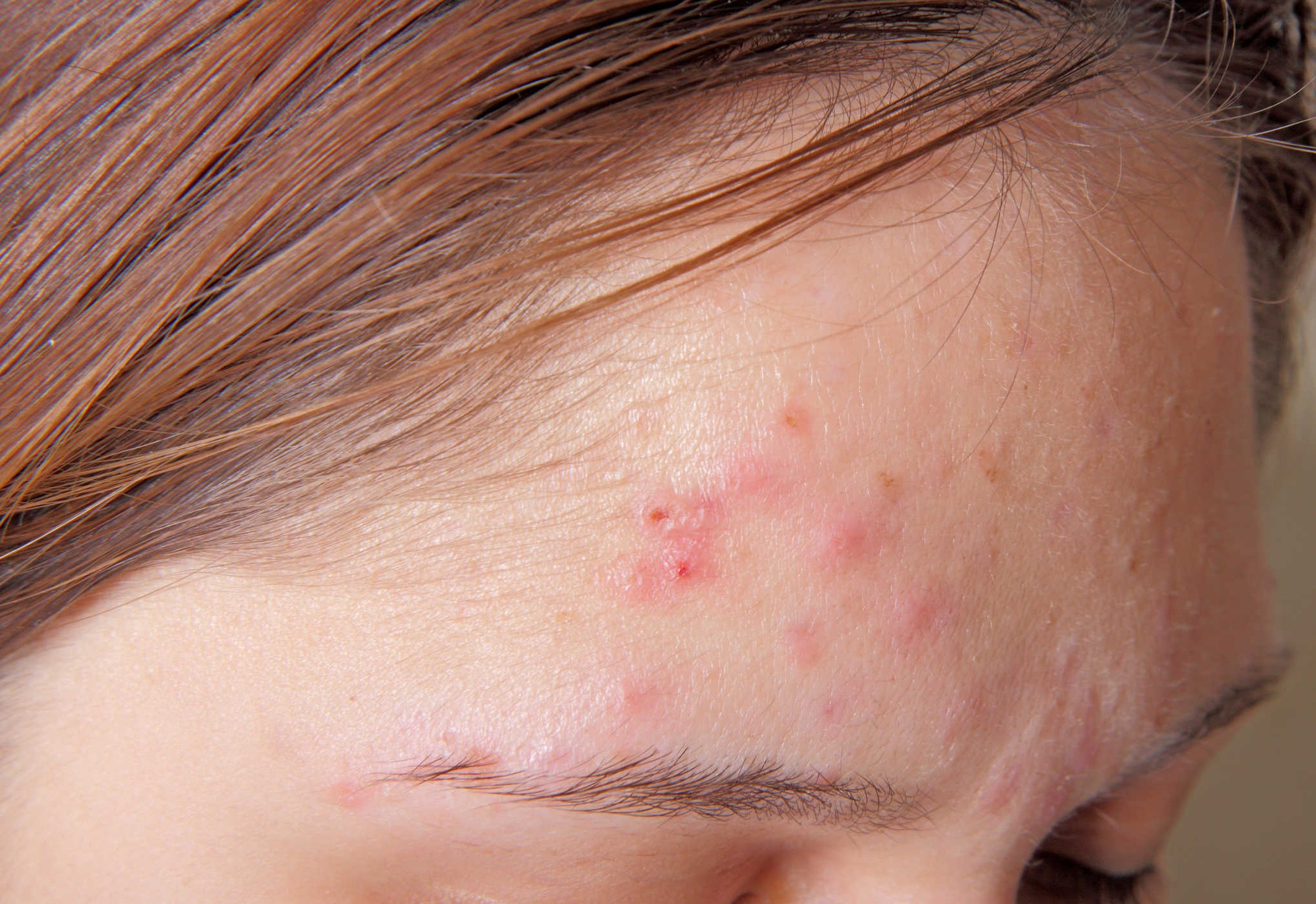 Trị mụn mãi mà vẫn không khỏi, có phải bạn đang mắc những sai lầm tai hại sau? - Ảnh 1. Trị mụn mãi mà vẫn không khỏi, có phải bạn đang mắc những sai lầm tai hại sau? - Ảnh 1.