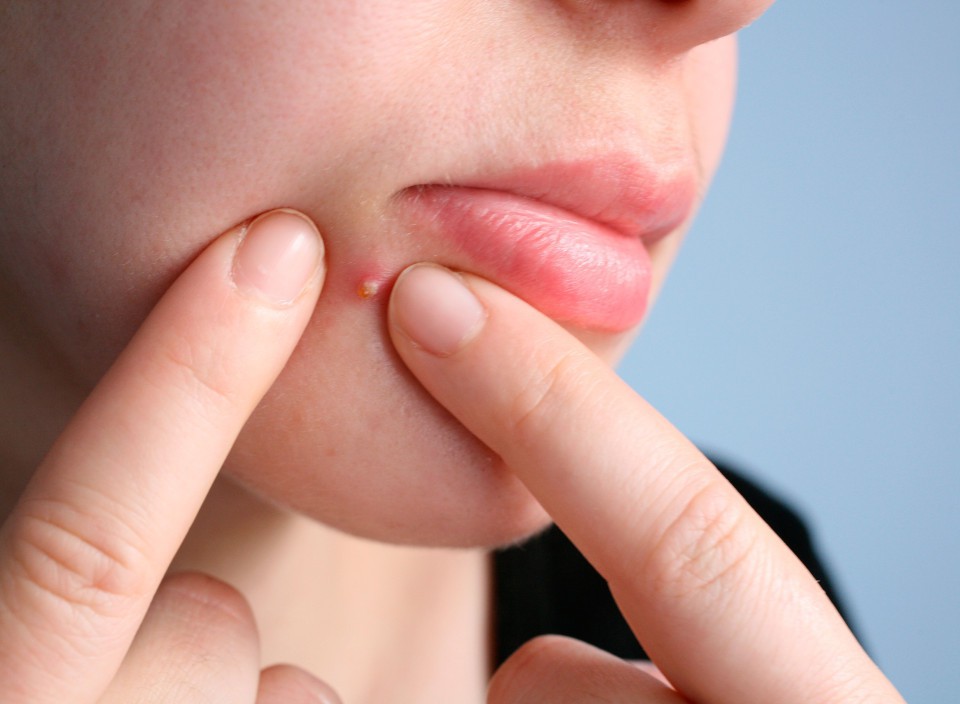 Trị mụn mãi mà vẫn không khỏi, có phải bạn đang mắc những sai lầm tai hại sau? - Ảnh 3. Trị mụn mãi mà vẫn không khỏi, có phải bạn đang mắc những sai lầm tai hại sau? - Ảnh 3.