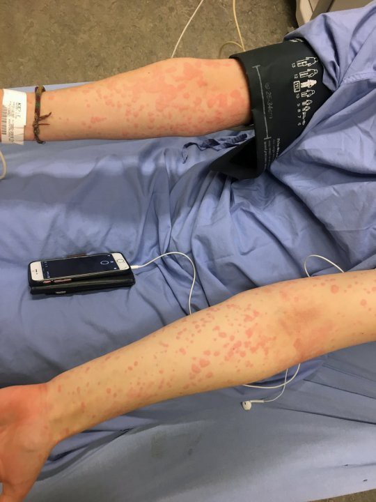 C&ocirc; g&aacute;i 21 tuổi v&agrave; chứng dị ứng m&ugrave;a đ&ocirc;ng kỳ lạ: Hễ nhiễm lạnh l&agrave; nổi mề đay, c&oacute; thể tử vong v&igrave; ngạt thở - Ảnh 4.