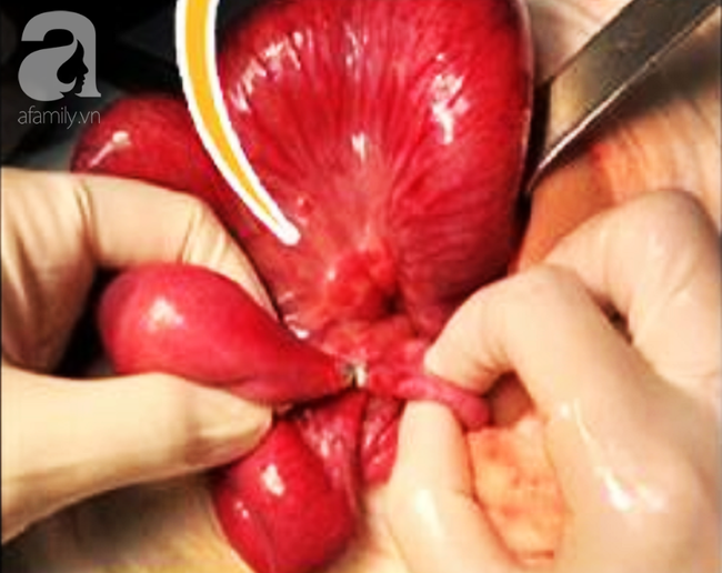 Hiểm họa kh&ocirc;n lường: Nuốt qu&agrave; sinh nhật mẹ mua, b&eacute; g&aacute;i 6 tuổi su&yacute;t chết v&igrave; thủng 4 lỗ ở ruột - Ảnh 2.