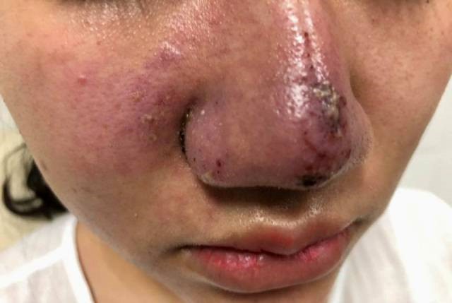 Từ trường hợp th&aacute;o độn cằm do ti&ecirc;m filler, c&ugrave;ng nh&igrave;n lại v&agrave; r&uacute;t ra b&agrave;i học sau v&ocirc; số ca biến chứng - Ảnh 3.