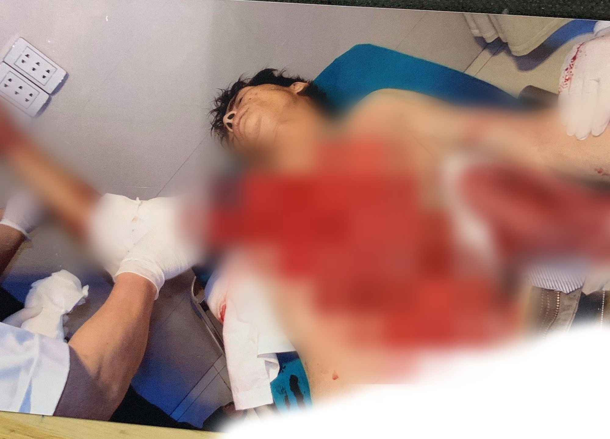 Tai nạn kinh hoàng: Ngã vào máy bóc gỗ, người đàn ông bị lột toàn bộ da phần ngực và tay - Ảnh 1. Tai nạn kinh hoàng: Ngã vào máy bóc gỗ, người đàn ông bị lột toàn bộ da phần ngực và tay - Ảnh 1.