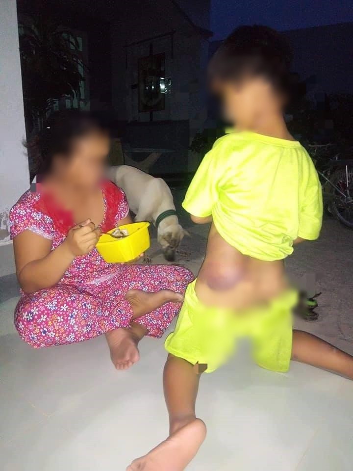 Long An: Bé trai khuyết tật 7 tuổi bị cô giáo đánh bầm tím cả cơ thể - Ảnh 1. Long An: Bé trai khuyết tật 7 tuổi bị cô giáo đánh bầm tím cả cơ thể - Ảnh 1.
