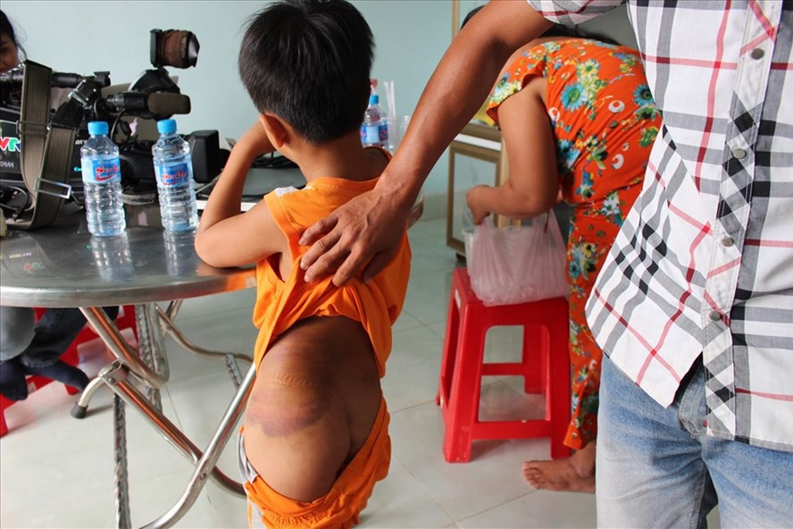 Vụ cô giáo đánh học sinh khuyết tật: Mẹ học sinh nhờ cô giáo đánh - Ảnh 1. Vụ cô giáo đánh học sinh khuyết tật: Mẹ học sinh nhờ cô giáo đánh - Ảnh 1.