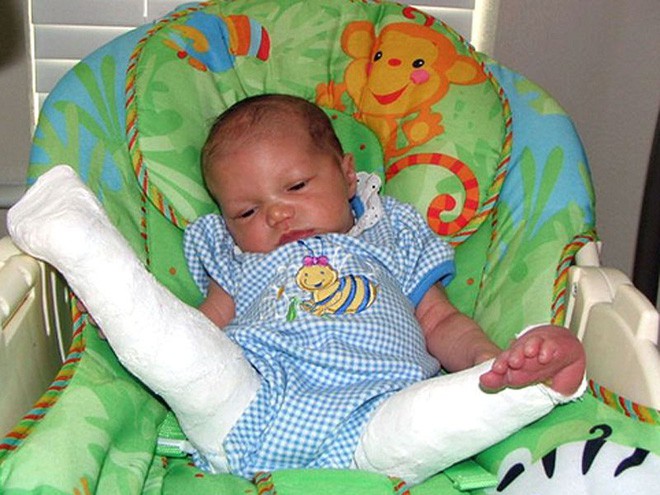 Sinh ra với đôi chân bị bẻ quặt ra phía trước, 8 năm sau, cô bé trở lại bệnh viện và khiến cho các bác sĩ tròn mắt kinh ngạc - Ảnh 1.